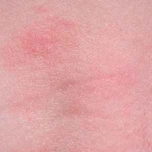 Article - Eczema Accalmie